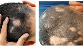 원형탈모(Alopecia areata) 관련이미지